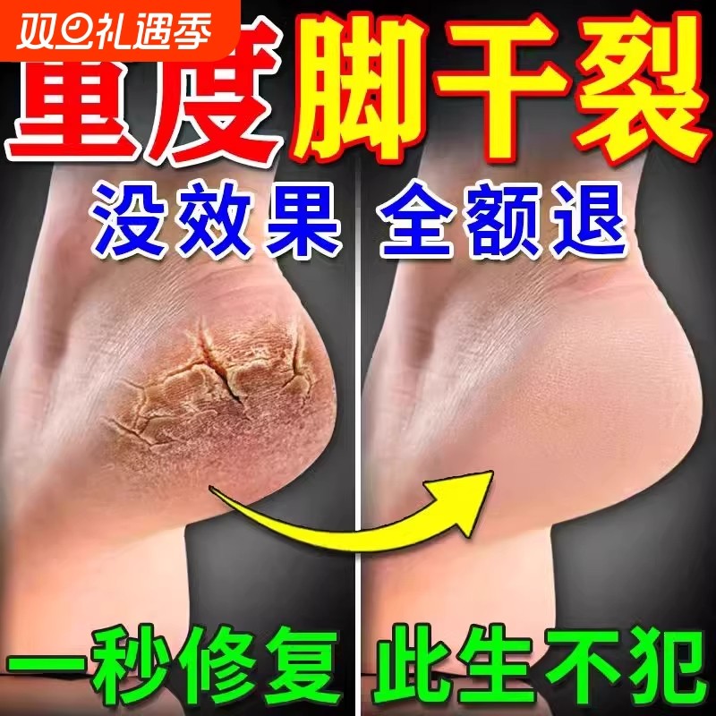 脚后跟干裂修复霜手足龟裂开裂皲裂治起皮去死皮润马油皱裂膏