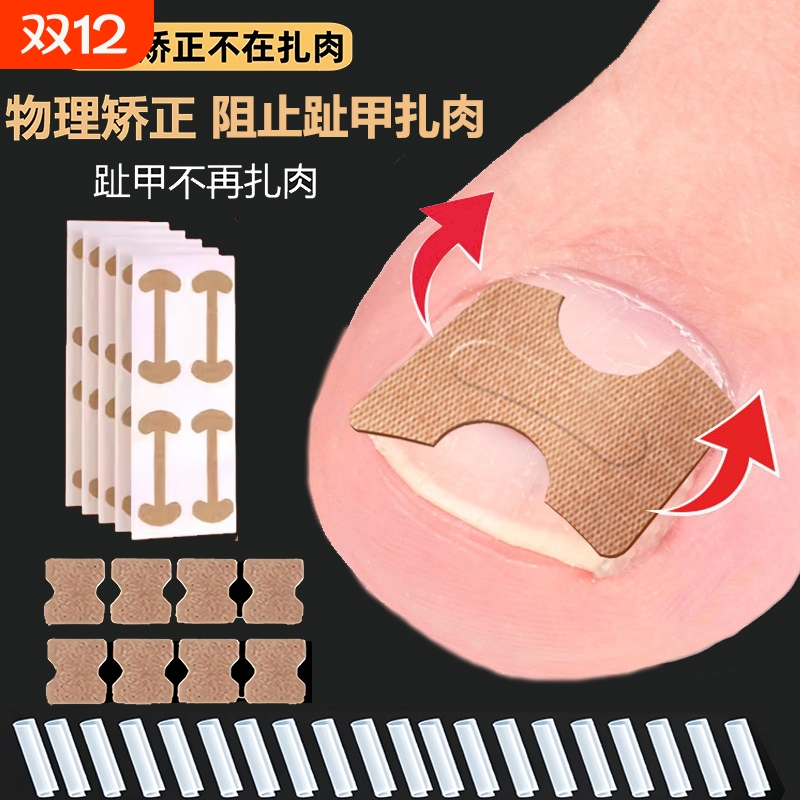 甲沟矫正器嵌甲贴片炎脚趾甲往肉里长脚指甲扎肉专用隔离垫片神器