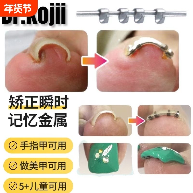 足科甲沟嵌甲指甲矫正器卷甲内嵌脚趾往肉里长专用正甲贴片炎,家庭/个人清洁工具,美甲/修甲套装,淘宝优惠券,粉丝福利购,淘宝优惠卷