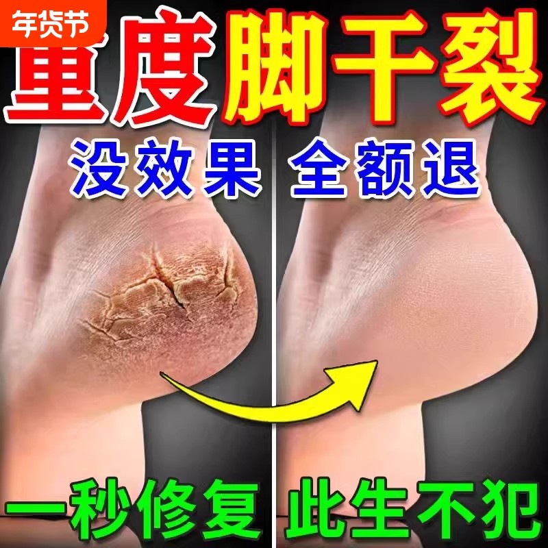 脚后跟干裂修复霜手足龟裂开裂皲裂治起皮去死皮润马油皱裂膏