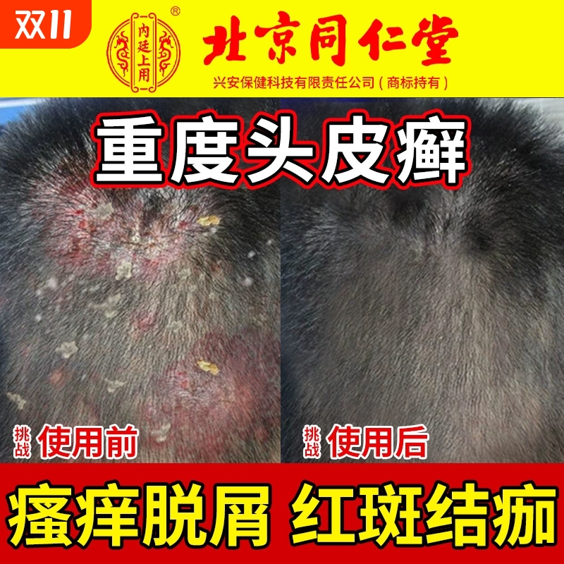 北京同仁堂头皮癣特真菌感染头皮屑脂溢性皮炎效止痒毛囊炎非药膏