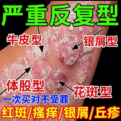 【牛皮藓癣专用】牛藓王第一名