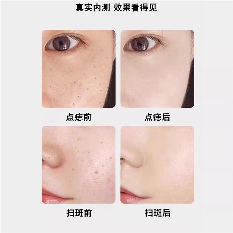 去除尖锐湿尤扁h平丝状尤神器激光点疣痣笔仪器脖子小肉粒祛斑扫