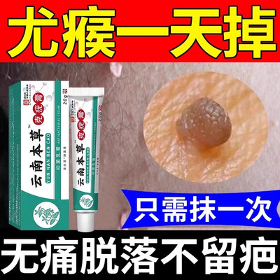 云南本草克疣膏去疣药水尤脖瘊子