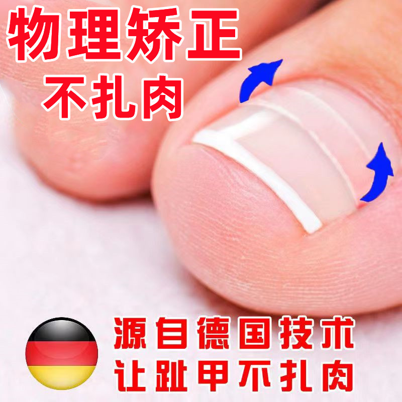 正甲贴片内嵌德国沟卷脚医生