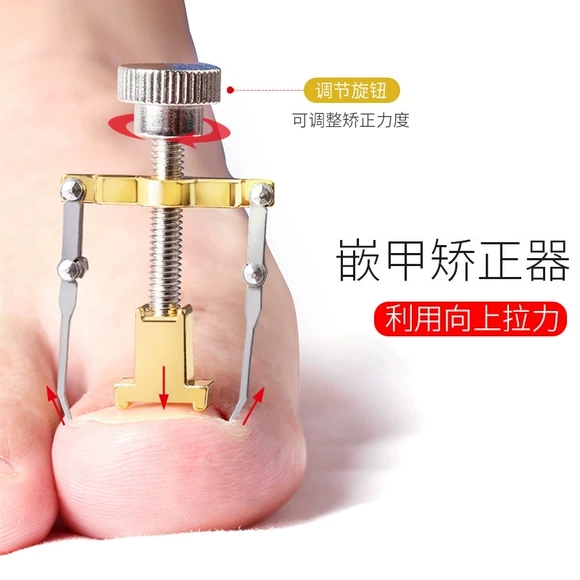 正甲贴甲沟矫正器脚趾指甲长肉里