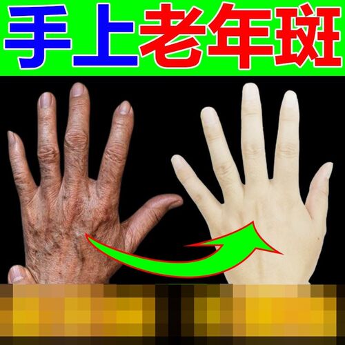 手上老年斑强力去除手部祛斑手背晒黑斑黑色素沉淀祛淡斑美白斑霜