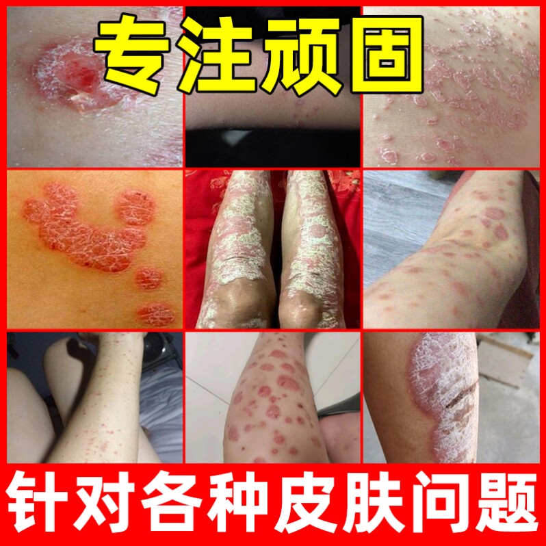 银屑癣外用药独家草本药膏治牛皮鲜藓治疗干疮的药手癣膏真菌感染