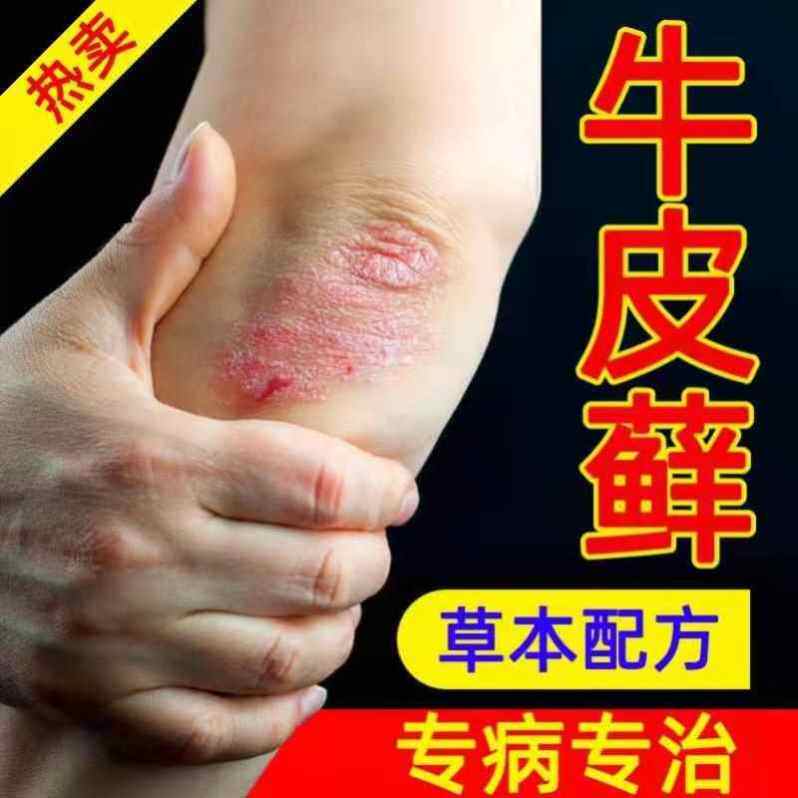 我要买真菌股廯体藓牛皮藓外用药牛皮藓皮肤消毒皮鲜膏皮肤护理