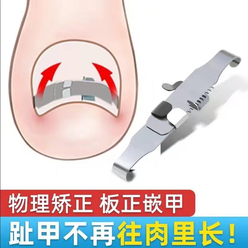 甲沟矫正器嵌甲矫正器正甲扣脚趾甲卷甲正甲贴片指甲长肉里炎