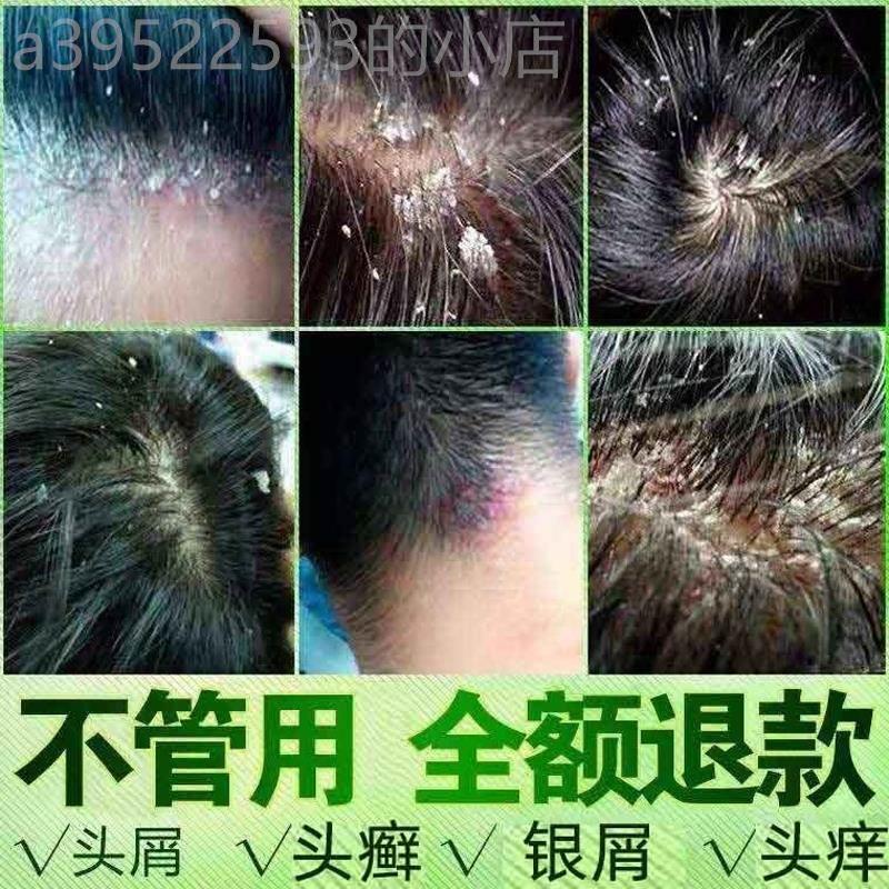 银屑癣外用头部瘙痒去屑廯藓止痒膏专用头皮癣治疗头皮痒的药儿童