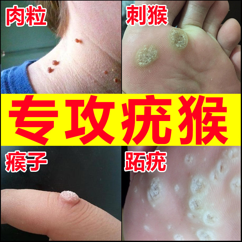 刺猴去除专用去肉粒疙瘩猴子鱼鳞痣祛瘊子神器一抹无忧肉刺膏非药_虎窝淘