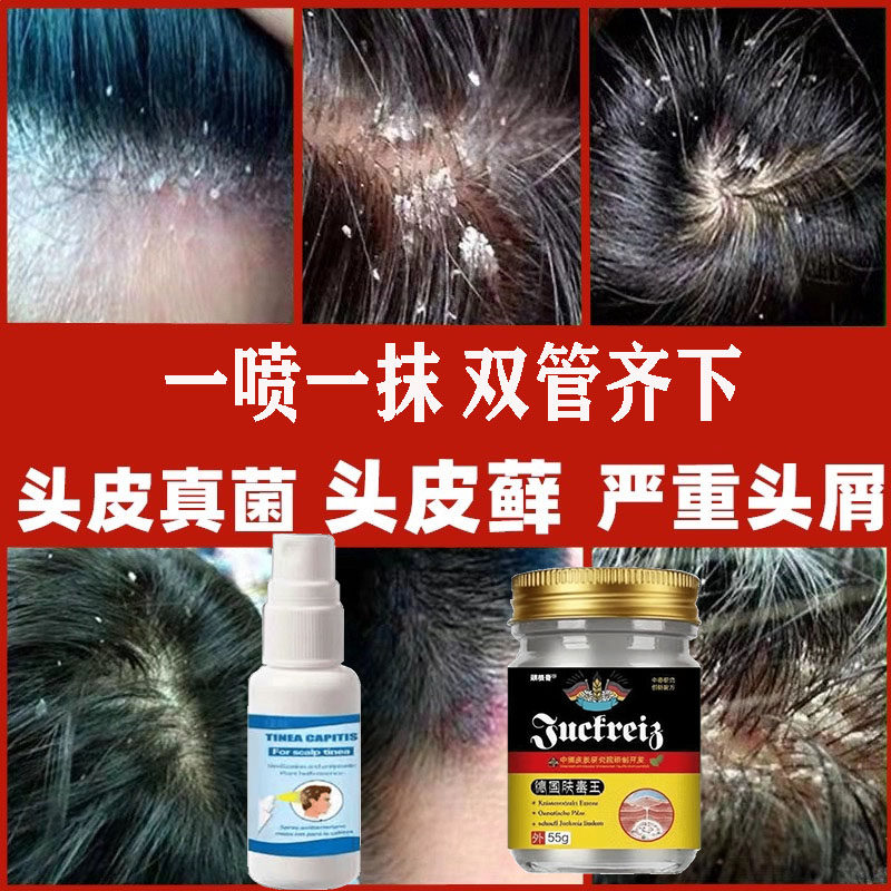 头皮屑脂溢性皮炎真菌感染头皮头部头痒毛囊炎喷剂