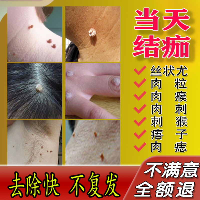 脖子上得小肉粒去除腋下小疙瘩