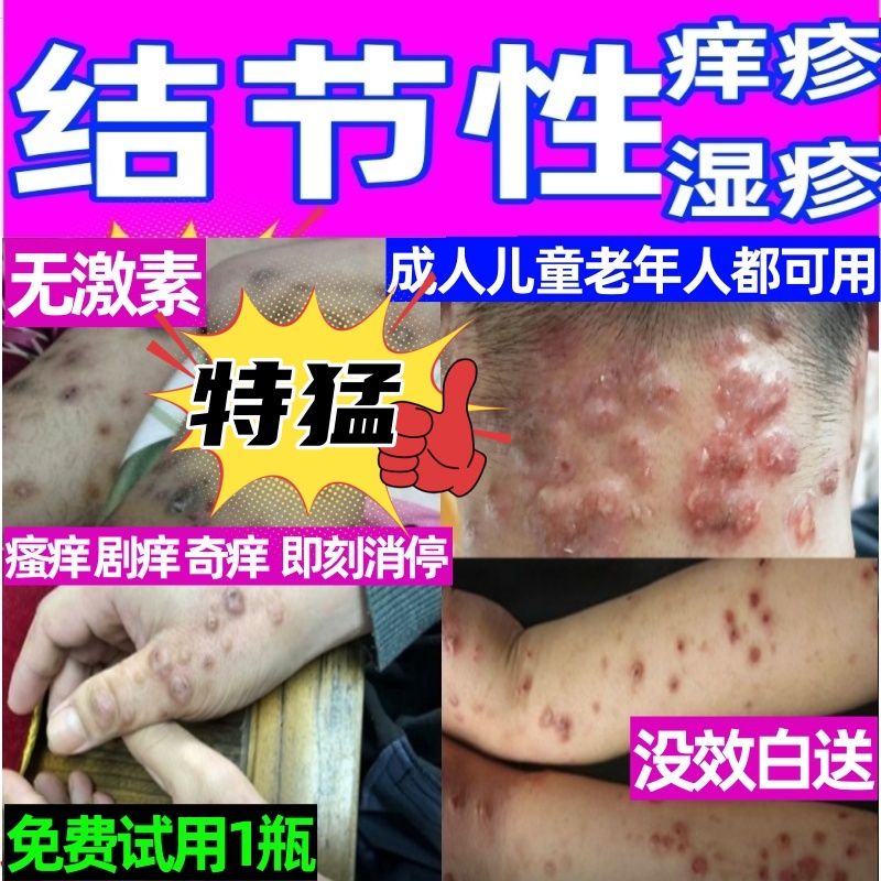癢疹膏特效藥1瓶抵10瓶普通藥膏