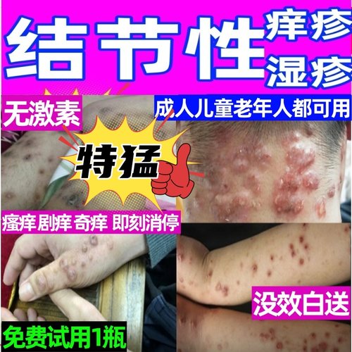 治结节性痒疹亚急慢性湿诊皮炎结节疙瘩全身止瘙痒红斑丘疱疹药膏