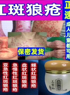 治系统性红斑狼疮外用药亚急性皮肤型急慢性蝶状盘状红斑狼疮克星