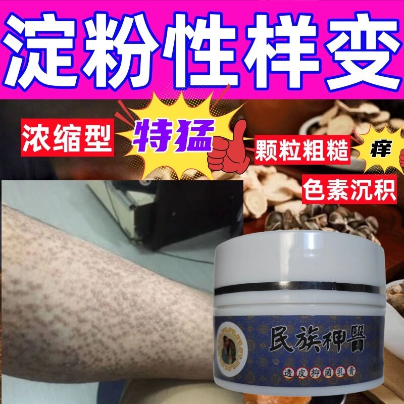 顽固皮肤淀粉性样变药胳膊小腿后背淀粉性样变色素颗粒止痒修复膏