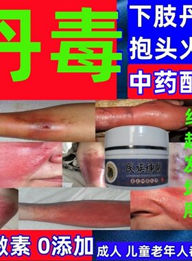 消丹毒外用老偏方纯草本无激素