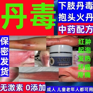消丹毒老偏方消肿止痛治下肢丹毒流火皮肤红肿灼热感染瘙痒专用
