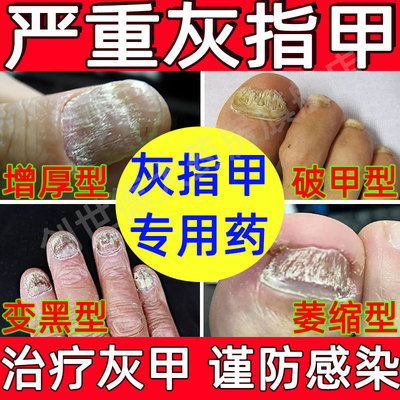 【太平】硝酸咪康唑乳膏2%*10g*1支/盒特非效真菌感染第灰指甲一名官方根旗舰店治专用