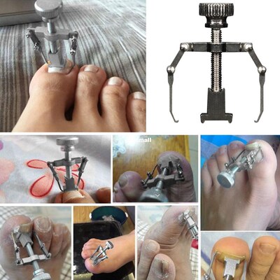 New Professional Orthodontic Stainless Steel Ingrown Toe Nai
