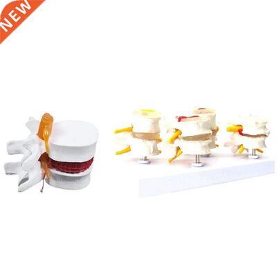 1 Pcs Skeleton Spine Lumbar Disc Herniation Teaching Model &