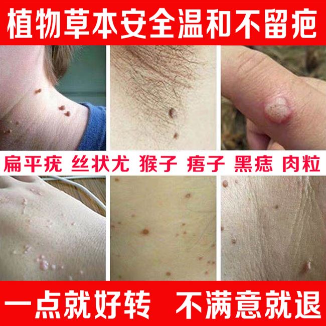 日本去肉刺丝状疣脖子腋下肉粒扁平疣的药脸部脚上长