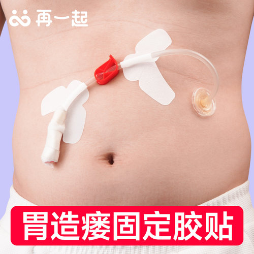 胃造瘘导管固定贴不滑脱不移位