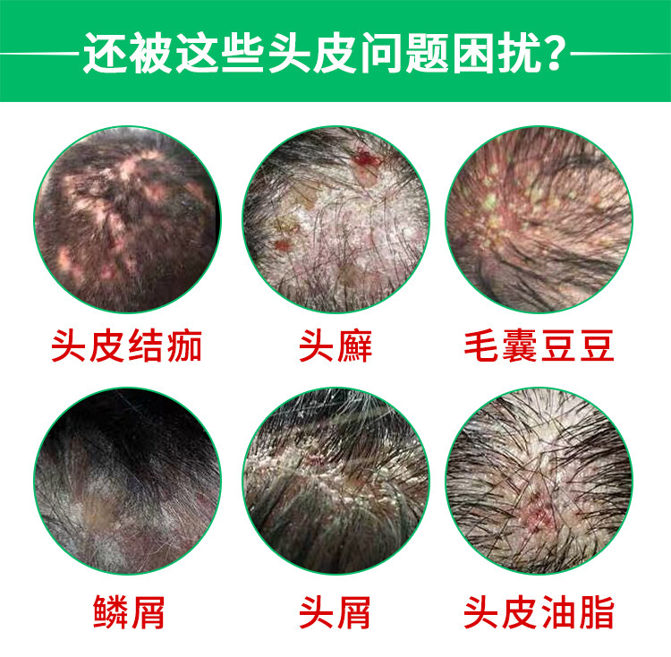 治疗毛囊炎头皮癣头皮脸头部头上长痘痘背上前胸后背私处专用药膏