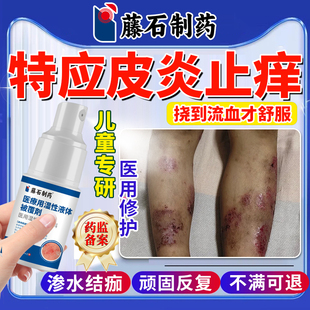儿童特应性皮炎止痒抑菌皮肤搭膏药贴特异性去专用根湿疹身体乳SE