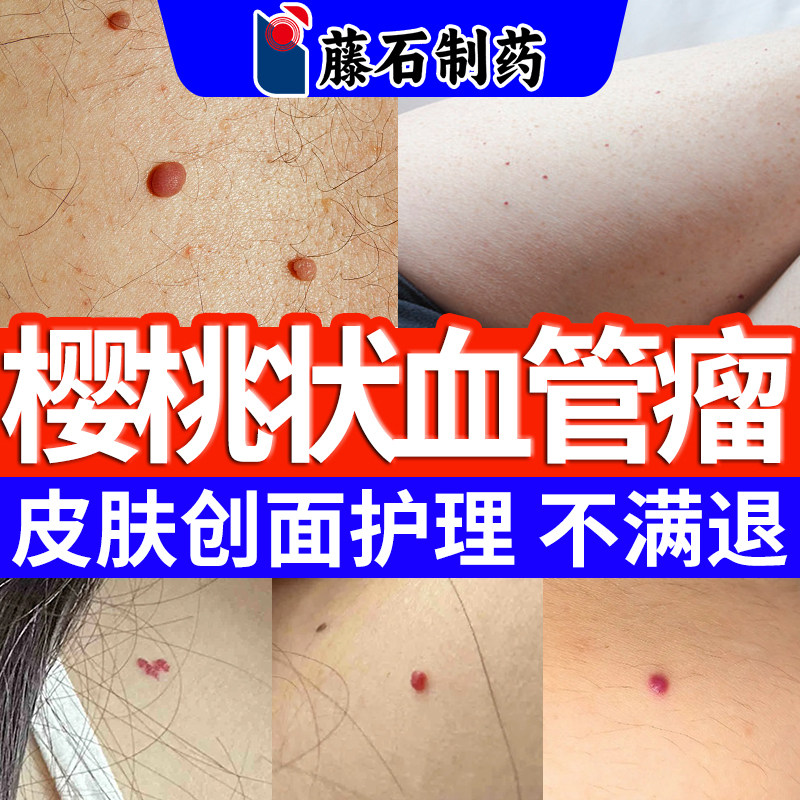 樱桃状血管瘤术后护理血管痣药监备案膏点红痣凝胶无痕正品去SE