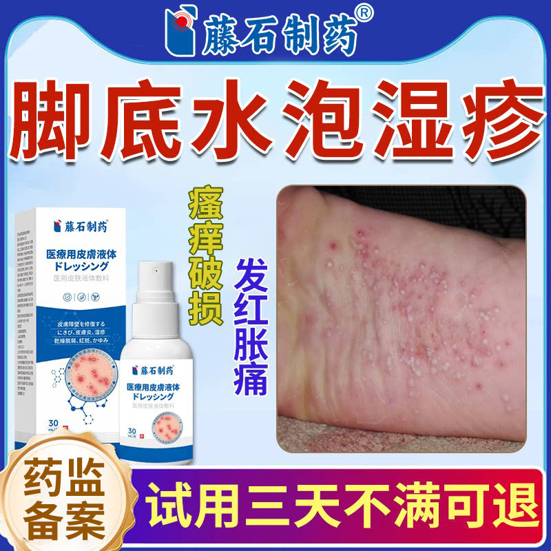 脚上水泡湿疹止痒去喷雾剂根脚底长小水泡真菌感染脱皮瘙痒SE