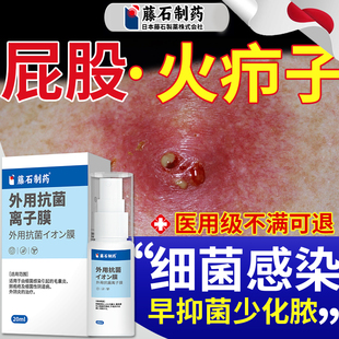 屁股上长疖肿火疖子拔毒拔脓膏喷剂搭膏药贴脓包硬块敷料吸脓贴SE