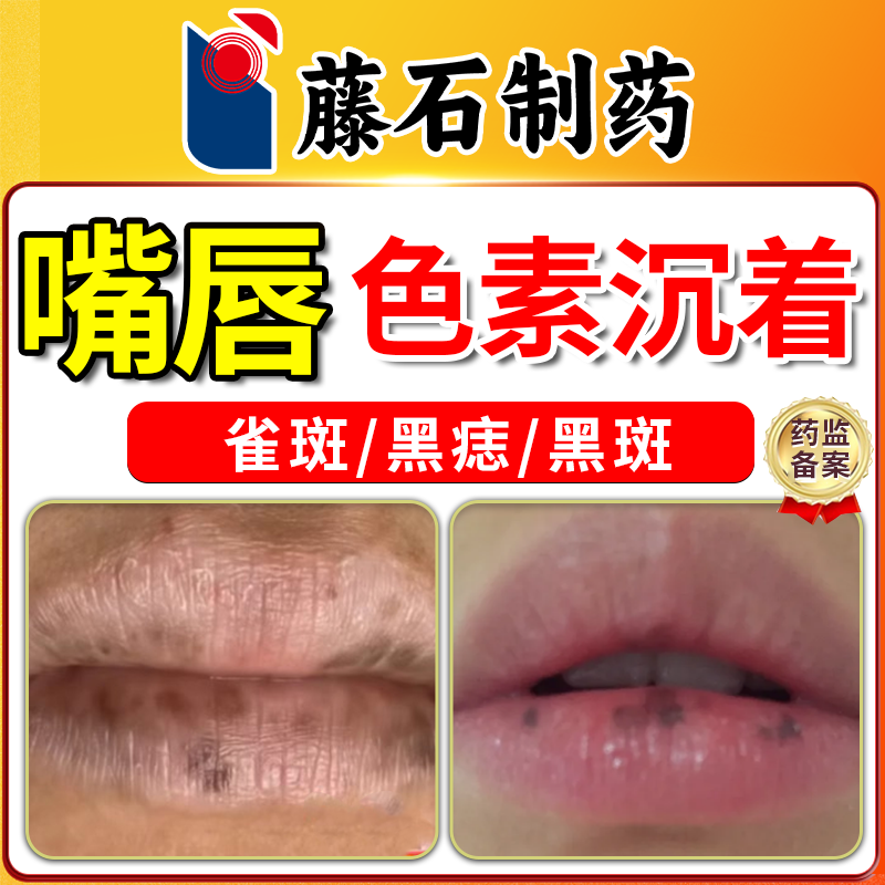 嘴唇黑斑引起黑色素沉淀唇部护理淡化黑色素唇周黑点黑痣去用除CS