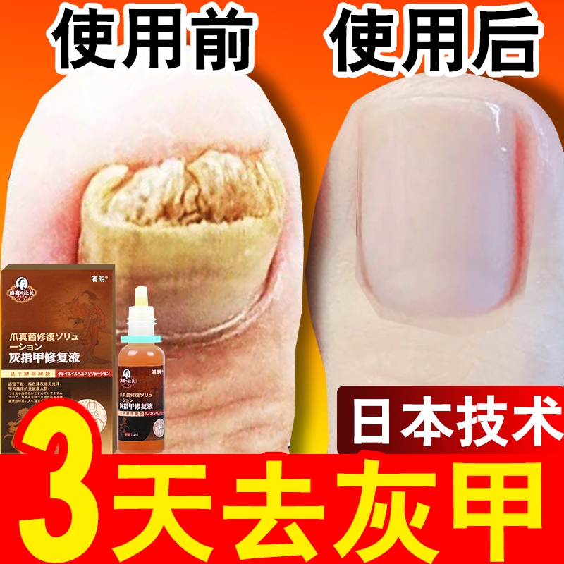 灰指甲非专脱甲膏增厚灰甲净脚趾甲用药膏软甲旗舰店抑菌治疗正品