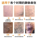 Сибангские вены, охлажденные компрессы, гелевые зеленые сухожилия, поднятые боль в ногах, болезненность, отек эритроцитов