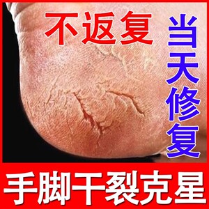 脚裂脚后跟干裂蛇油膏修复手脚干裂脚后跟干裂起硬皮足跟开裂