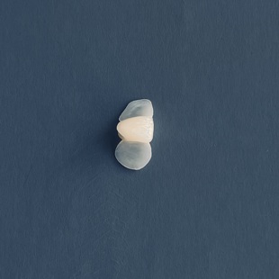 拔牙缺牙种植牙马里兰桥HPP粘结桥老人假牙缺失牙活动假牙牙套