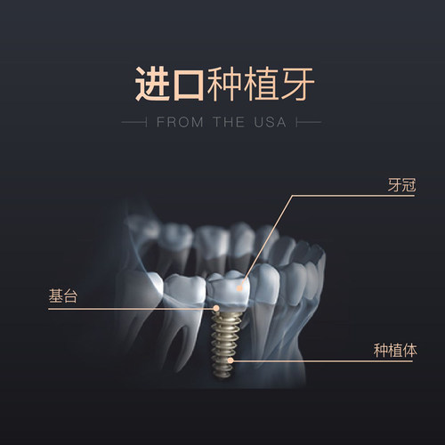 戴立克全瓷牙种植牙套餐种牙植牙种植牙齿全口牙种植植体假牙缺牙