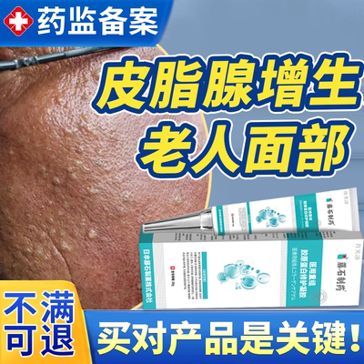 【速发】脸部老年性皮脂腺增生膏