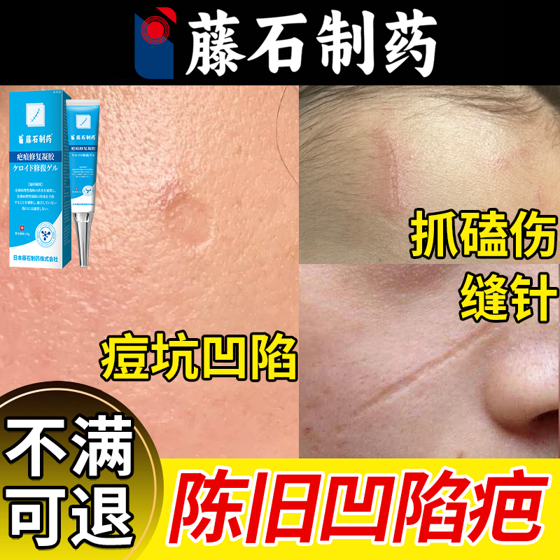 【速发】脸上凹陷性疤痕填充凝胶