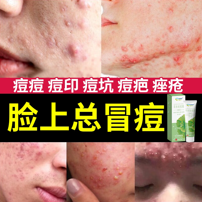 痘痘修复消炎医用祛痘印淡化却去痘印痘坑痘疤豆豆贴药房同款膏ys