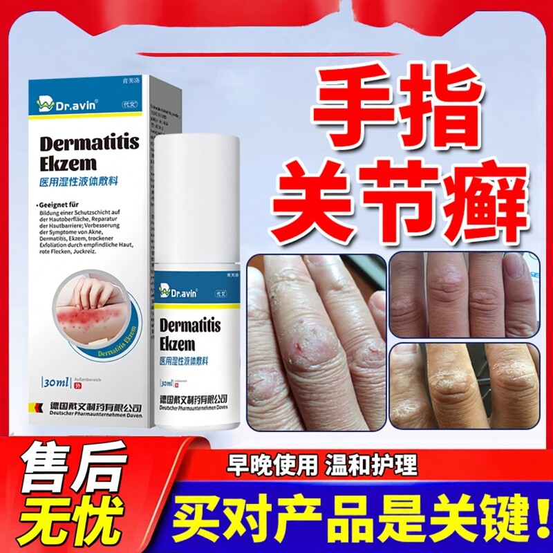 手指关节癣真菌感染脱皮干裂手癣膏藓去手足药房同款膏鹅掌风YS