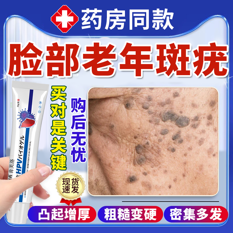 去脸上凸起老年斑老人疣扁平疣脂溢性角化病手背一抹灵去除软膏YS
