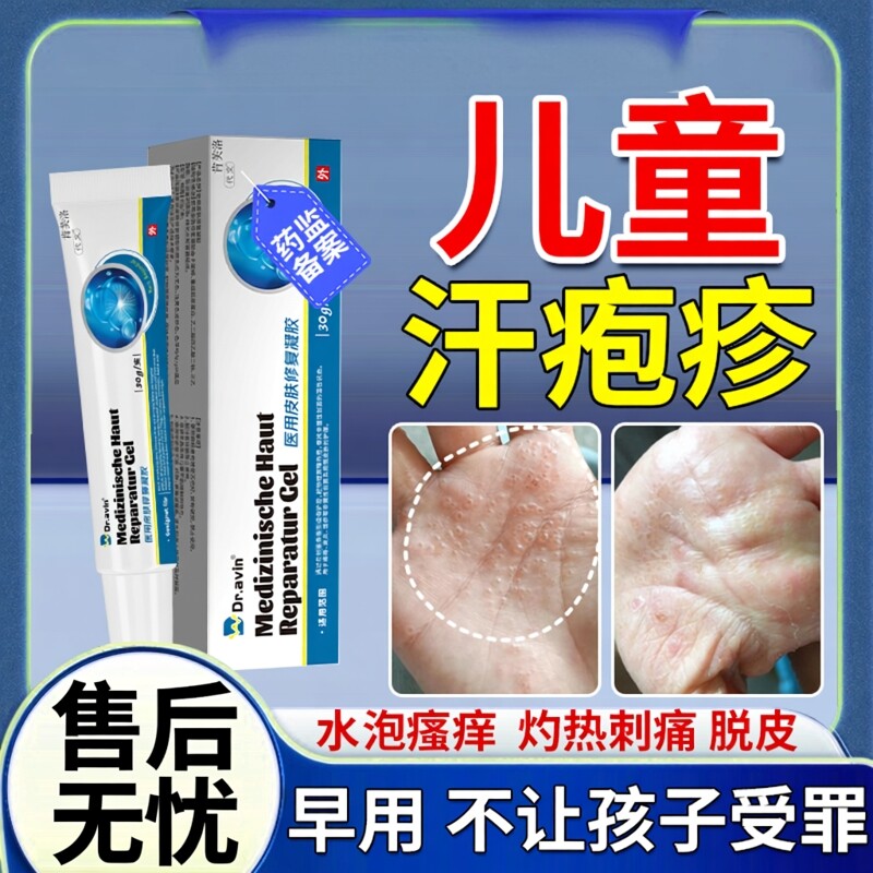 儿童汗疱疹药监备案膏止痒去汗状疱疹泡疹根手痒起水泡真菌感染YS