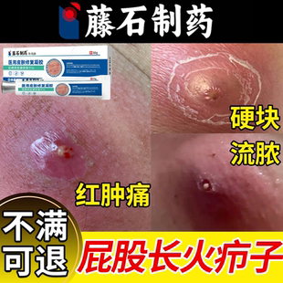 屁股上长火疖子疖肿拔毒膏拔脓膏特消敷料贴硬块炎药房同款膏效YS