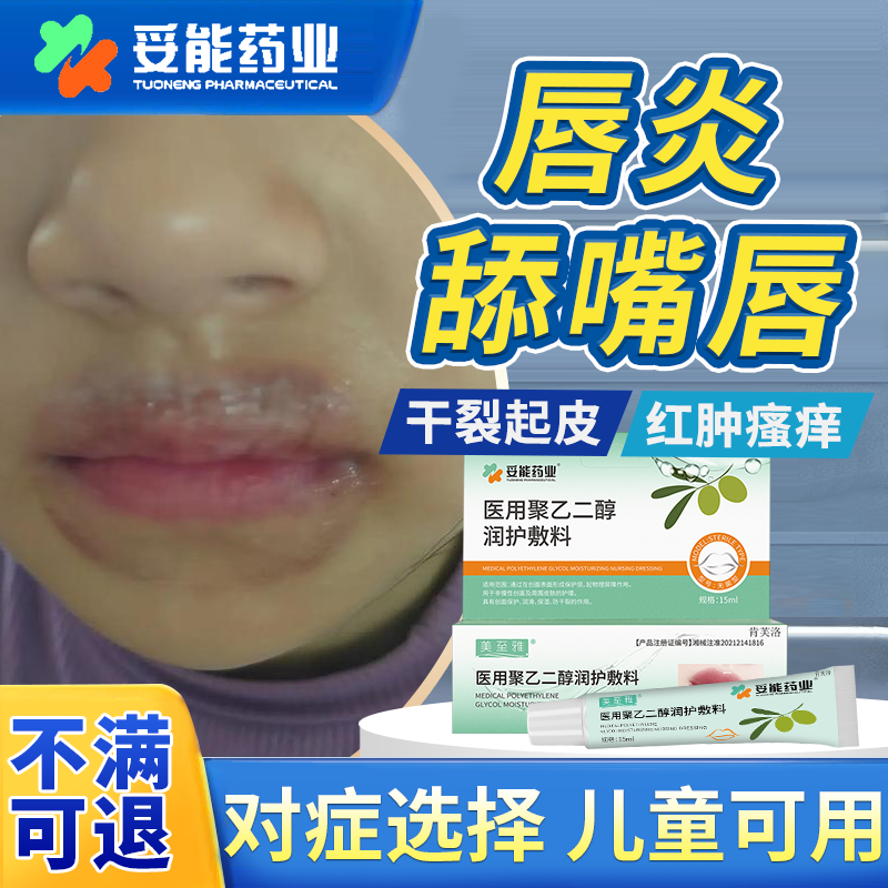 速发】唇炎舔嘴唇一圈红干痒红肿