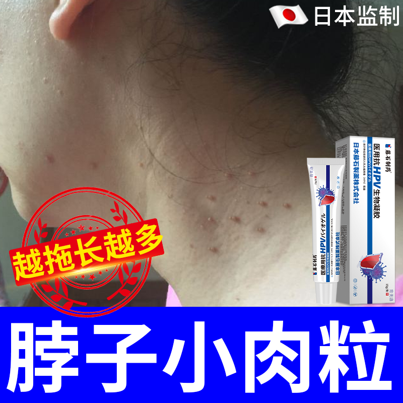速发】脖子疣瘊肉粒膏