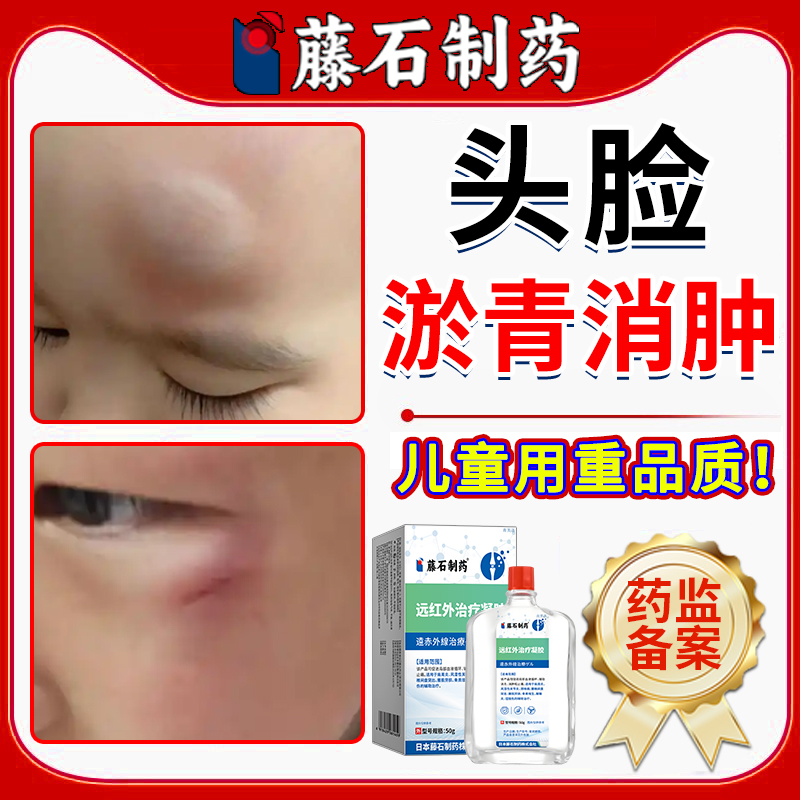 儿童脸上磕碰红肿淤青